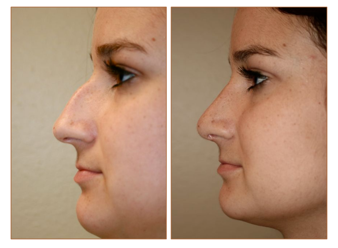 Average Cost of a Rhinoplasty or Nose Job is $3500.00-7500.00 The Cost will...