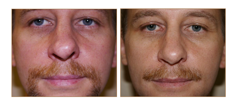 Rhinoplasty Nose Job Picture Gallery | CHRISTOPHER T. JOHNSON, DMD, FACS